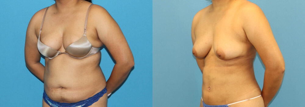 Liposuction case #6011