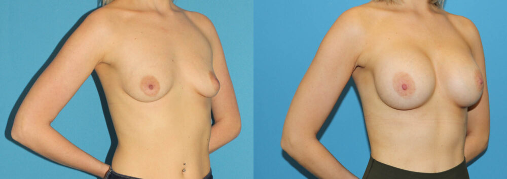 Breast Augmentation case #6279