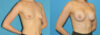 Breast Augmentation case #6279 slider thumbnail