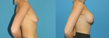 Breast Augmentation case #6279
