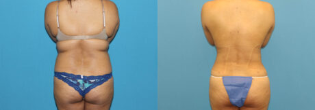 Liposuction case #6011
