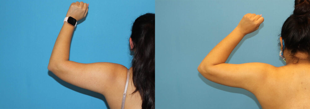 Liposuction case #6011