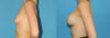 Breast Augmentation case #6279 slider thumbnail