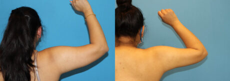 Liposuction case #6011