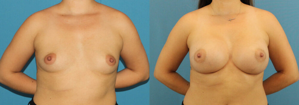 Breast Augmentation case #6285