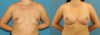 Breast Augmentation case #6285 slider thumbnail