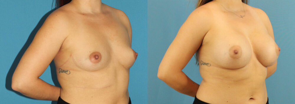 Breast Augmentation case #6285