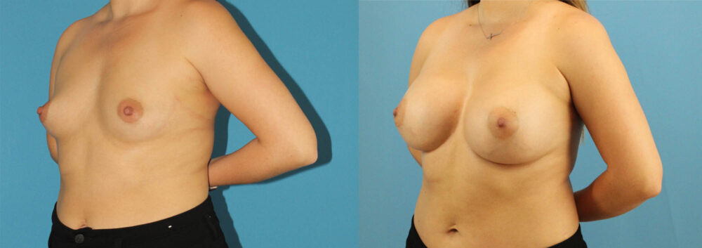 Breast Augmentation case #6285