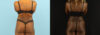 Liposuction case #6012 slider thumbnail