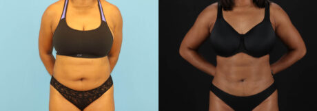 Liposuction case #6013