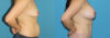 Breast Augmentation case #6291 slider thumbnail