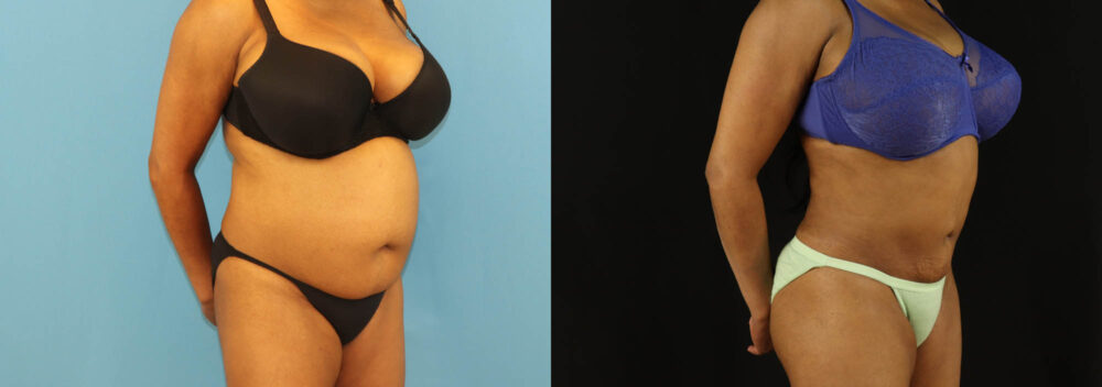 Liposuction case #6014