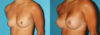 Breast Augmentation case #5997 slider thumbnail