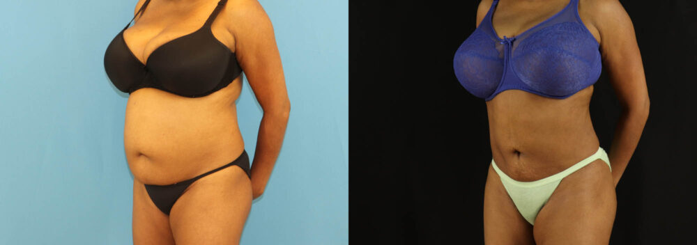 Liposuction case #6014