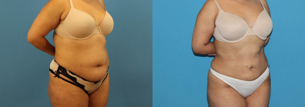 Liposuction case #6010