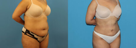 Liposuction case #6010
