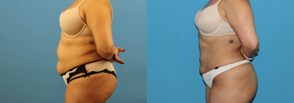 Liposuction case #6010
