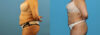 Liposuction case #6010 slider thumbnail