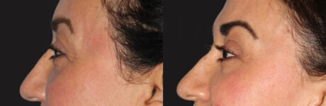 Blepharoplasty case #6888