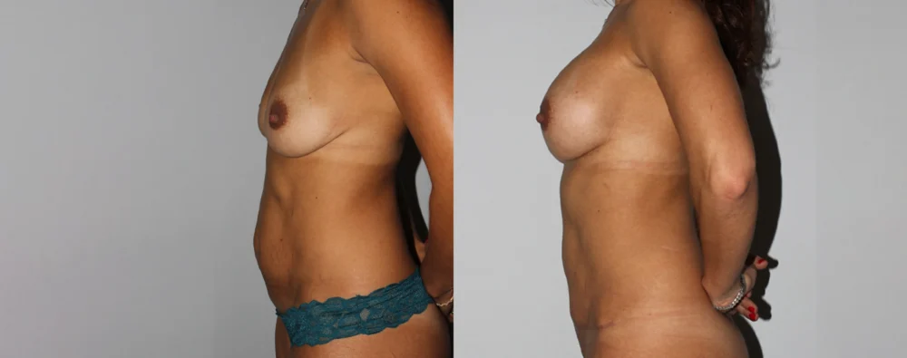 Mommy Makeover case #6504