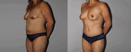 Mommy Makeover case #6503