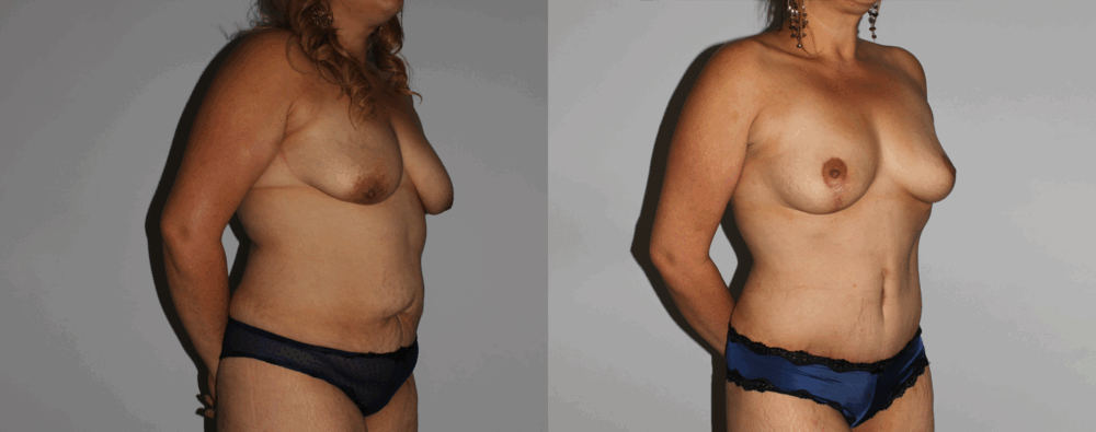 Mommy Makeover case #6503