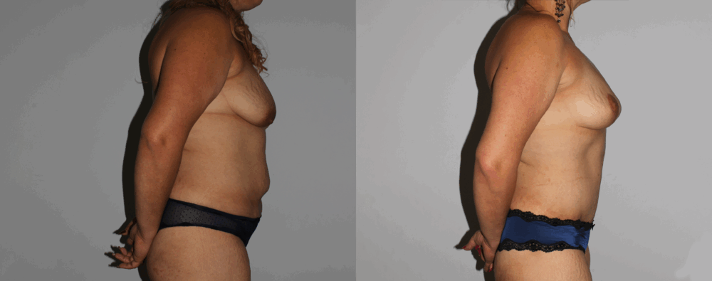 Mommy Makeover case #6503