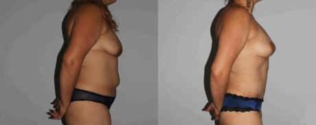 Mommy Makeover case #6503