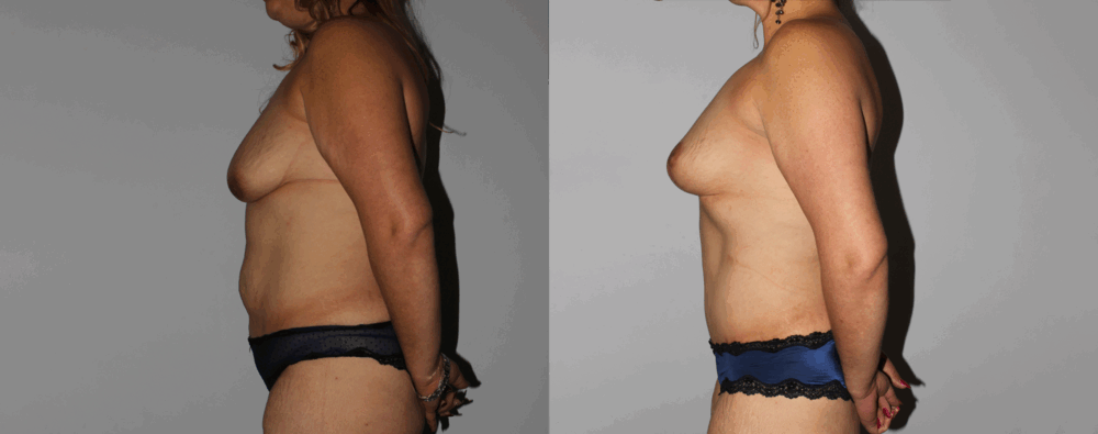 Mommy Makeover case #6503