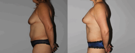 Mommy Makeover case #6503