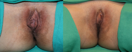 Labiaplasty case #5801