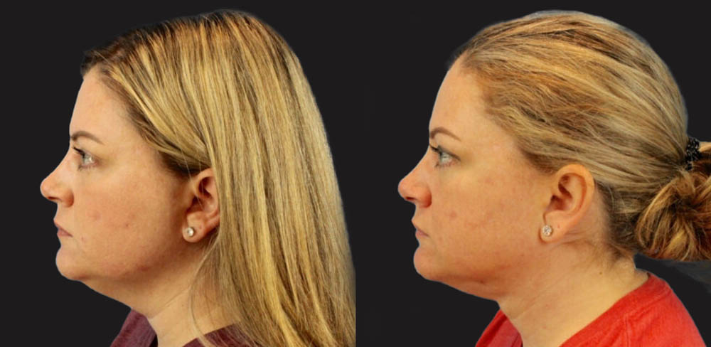 Submental Liposuction case #6944