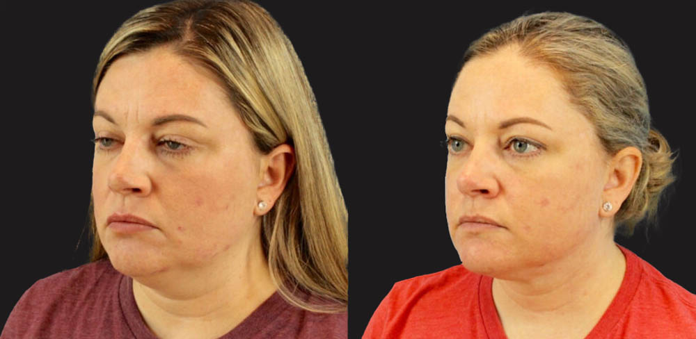 Submental Liposuction case #6944