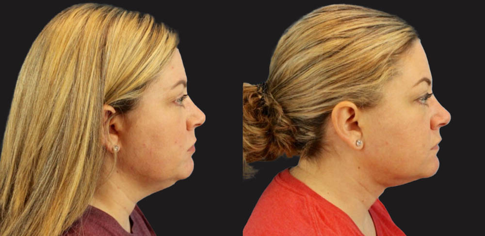 Submental Liposuction case #6944