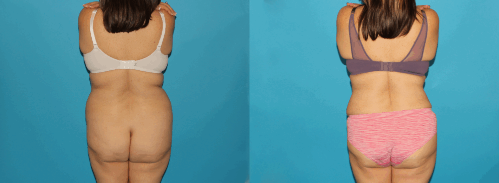 Tummy Tuck case #7171