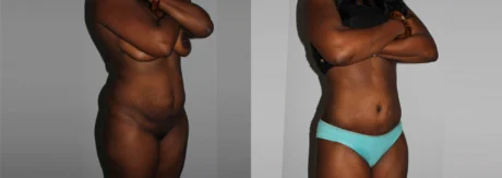 Brazilian Butt Lift case #4471