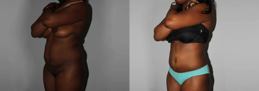 Brazilian Butt Lift case #4471