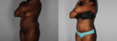 Brazilian Butt Lift case #4471