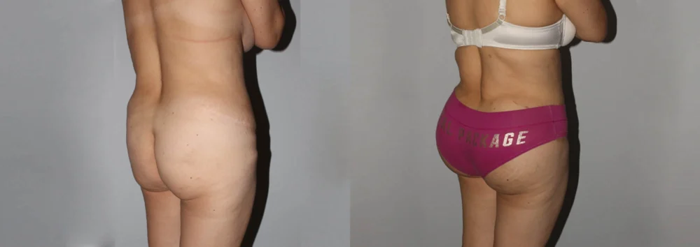 Brazilian Butt Lift case #4725