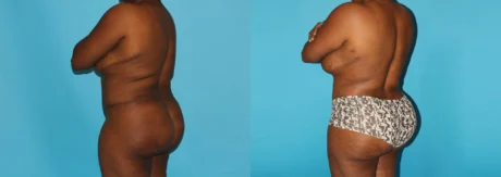 Brazilian Butt Lift case #4513