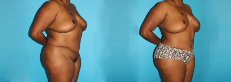 Brazilian Butt Lift case #4513