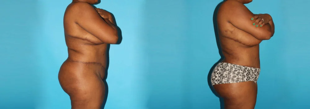 Brazilian Butt Lift case #4513