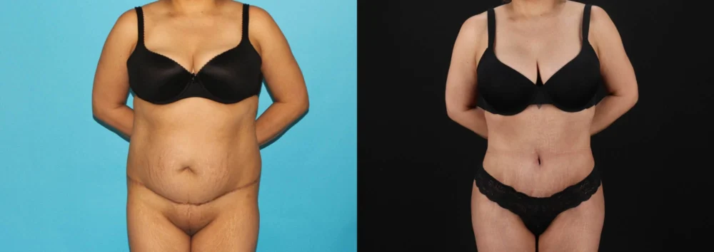 Brazilian Butt Lift case #4537