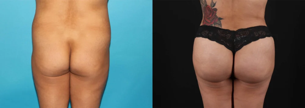 Brazilian Butt Lift case #4537