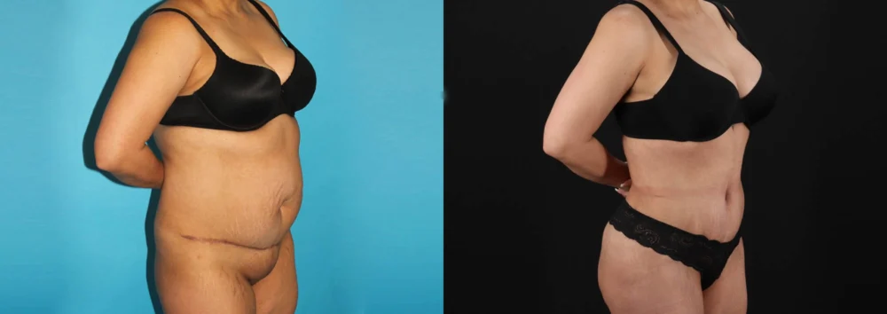 Brazilian Butt Lift case #4537