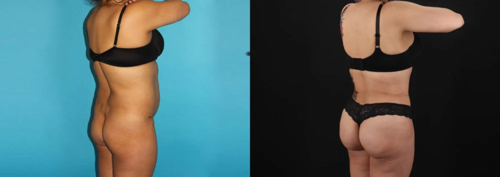 Brazilian Butt Lift case #4537