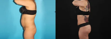 Brazilian Butt Lift case #4537