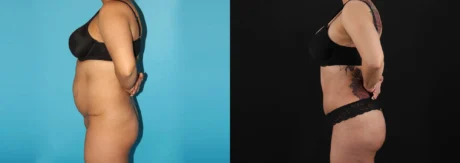 Brazilian Butt Lift case #4537