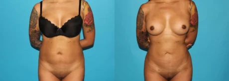 Brazilian Butt Lift case #4764