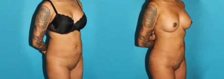 Brazilian Butt Lift case #4764